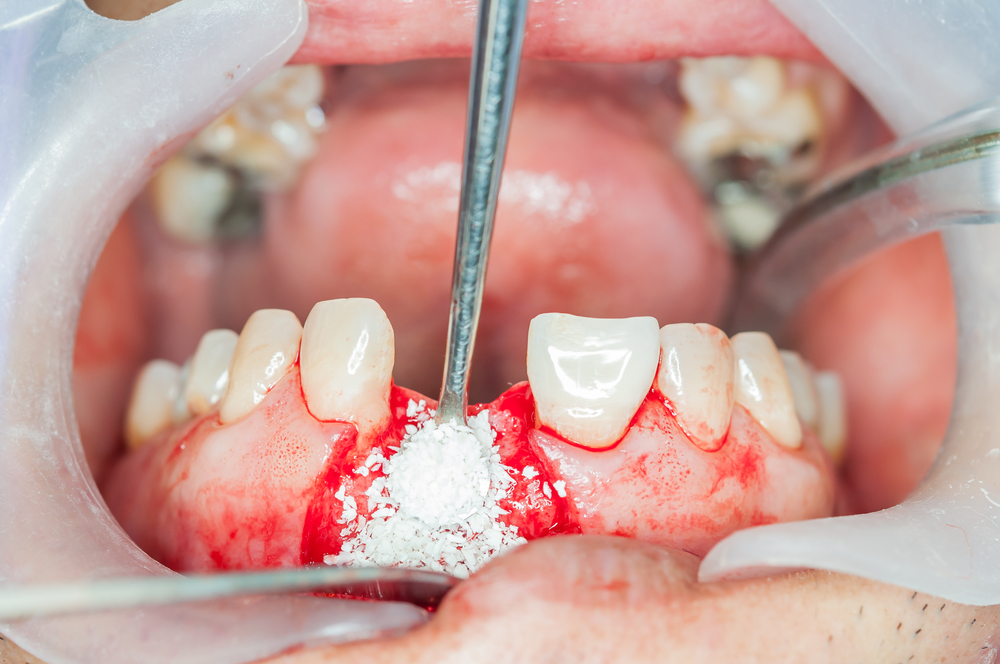 Grow Your Own Bone? Bone Grafting Is Routine - Desert