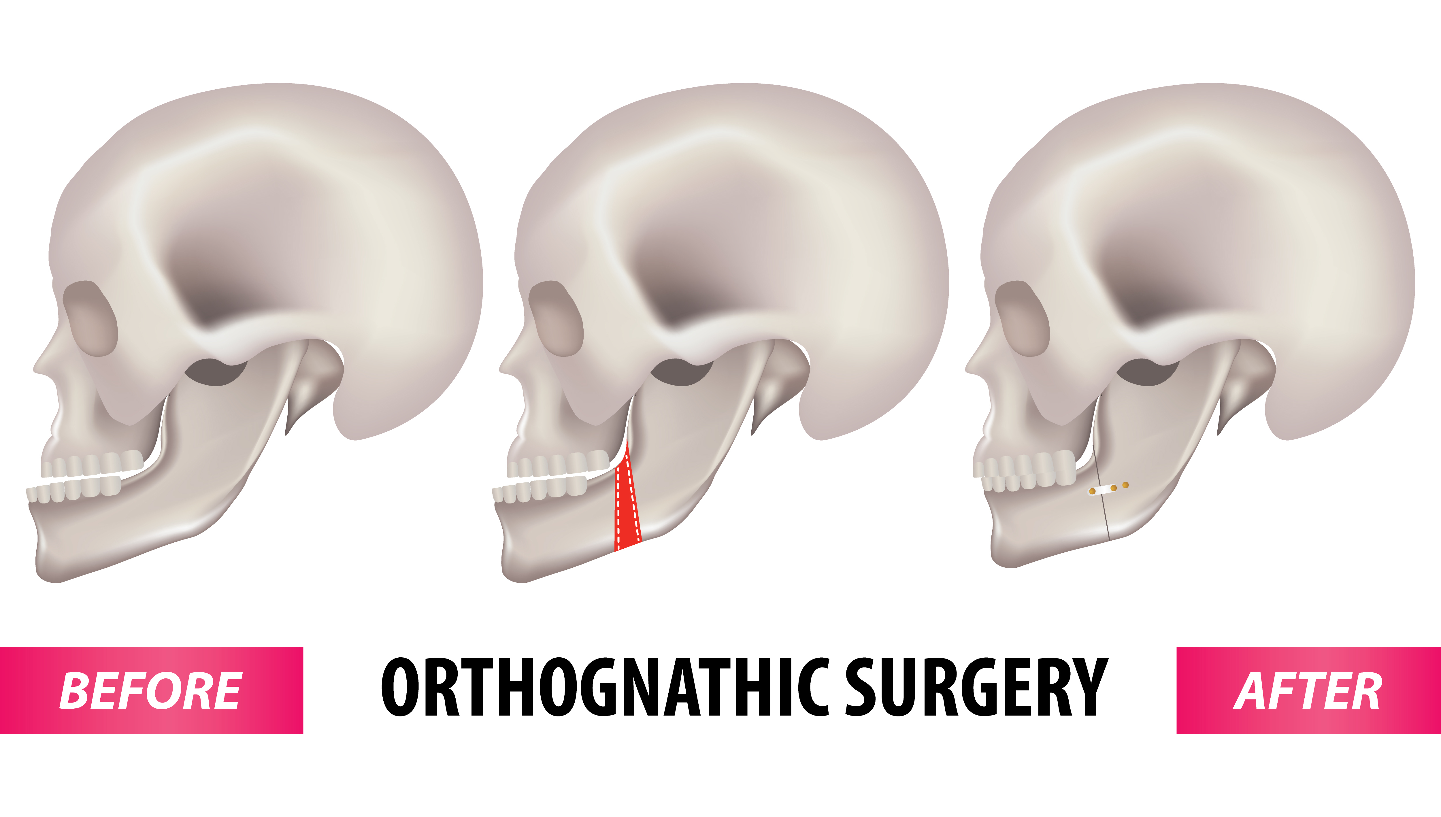 the-benefits-of-jaw-surgery