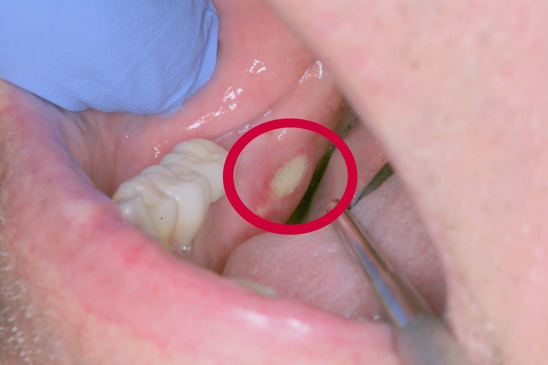 White Spot On Gums After Tooth Removal