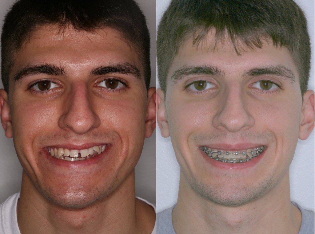 Corrective Jaw Surgery Orthognathic Surgery Misaligned Jaws